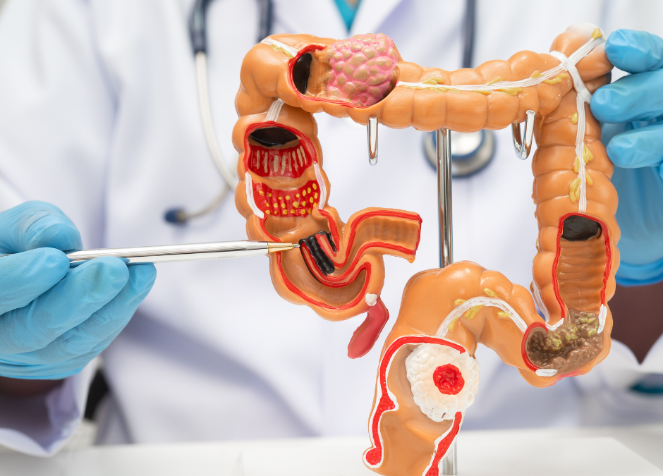 Fábrica de alimentos é condenada por dispensar operador com doença de Crohn